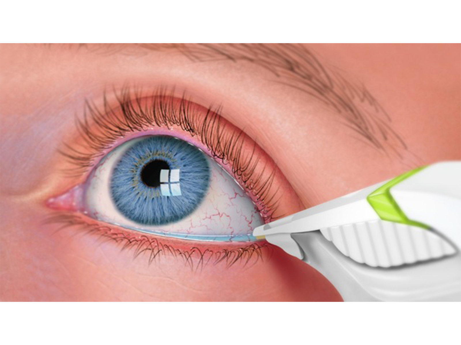 TearLab Glens Falls Eye Associates, PC